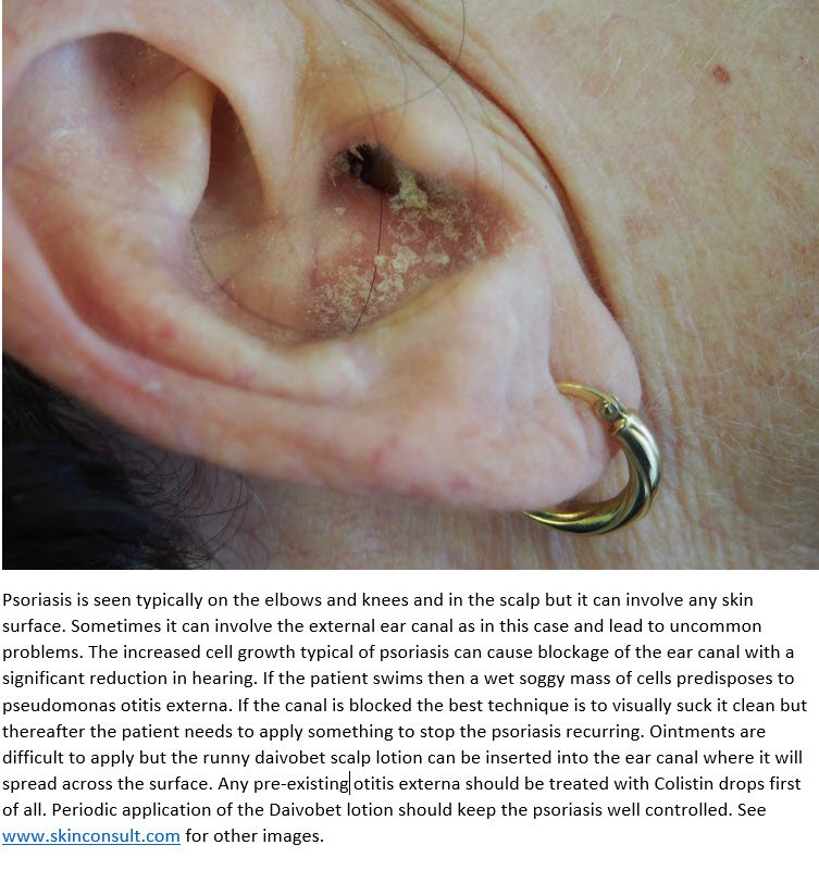 Consultations in Dermatology: Psoriasis ear canal