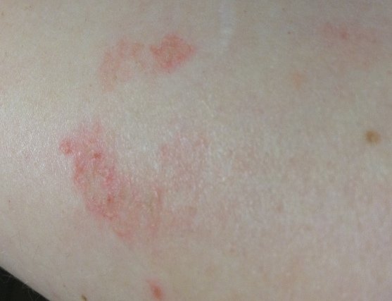 Could it be psoriasis?