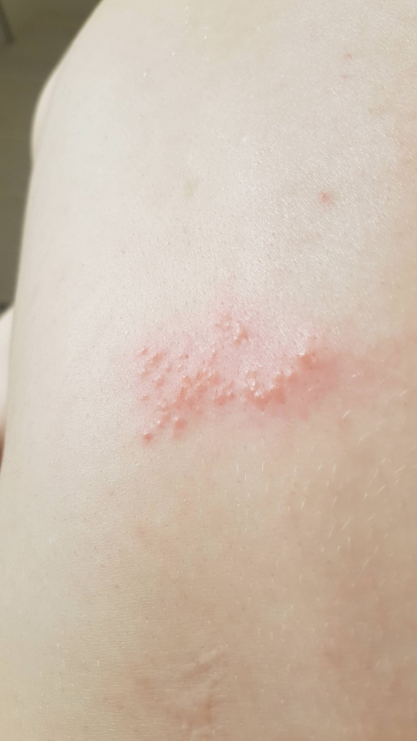 Could this be another Psoriasis breakout or something else? : Psoriasis