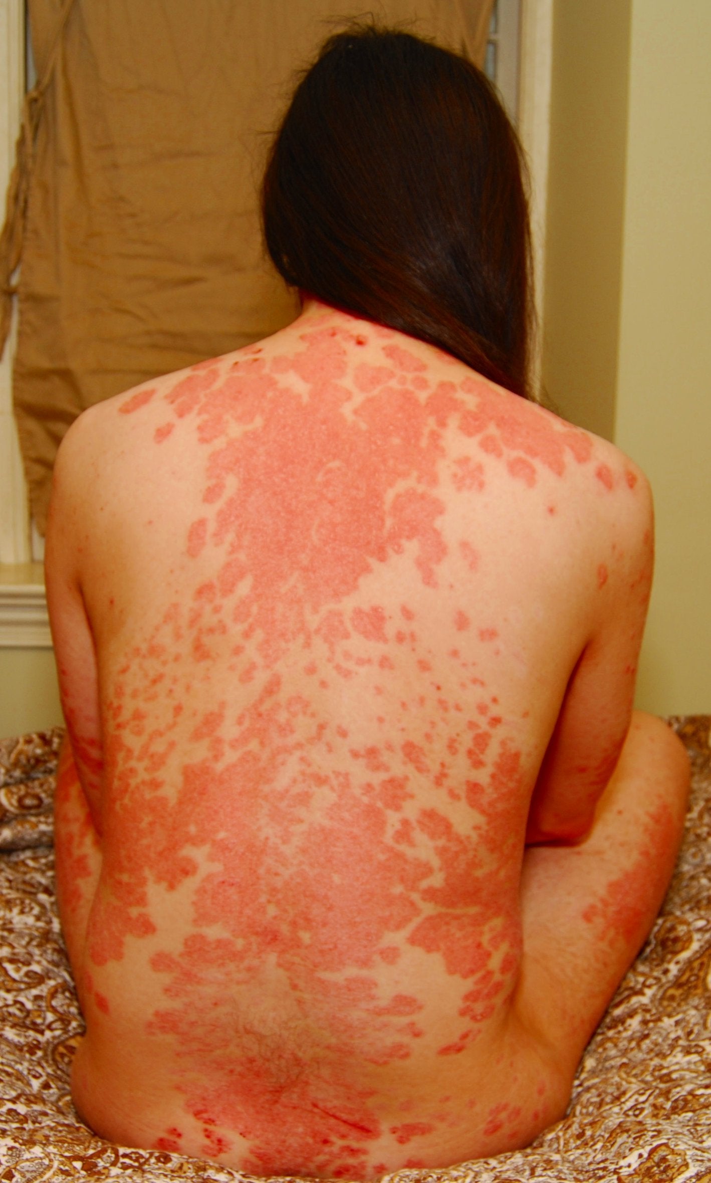 Dear reddit, I have severe psoriasis over almost 90% of my ...