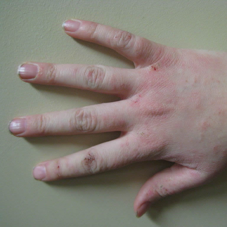 Dermatitis, Psoriasis, Eczema and Rosacea