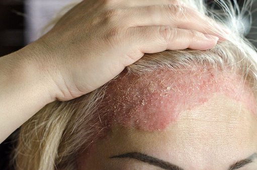 Dermatological Skin Disease Psoriasis Eczema Dermatitis ...