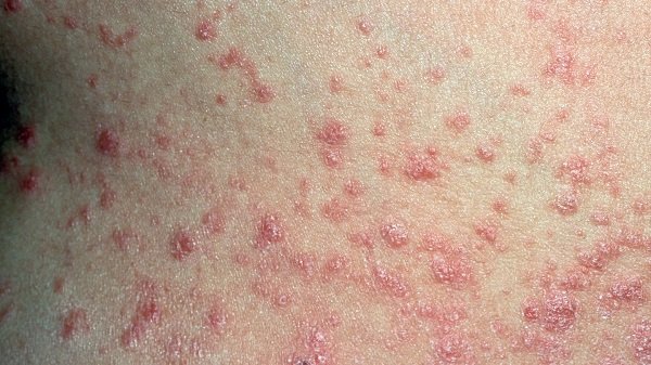 Describe The Symptoms Of Psoriasis. Are They Really Harmful?