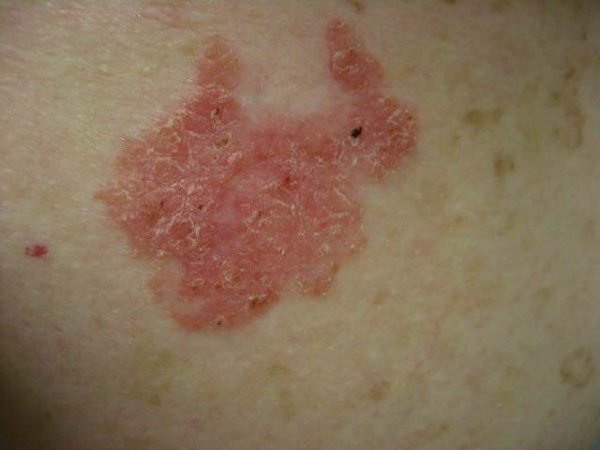 Diabetes risk increased in those with severe psoriasis ...