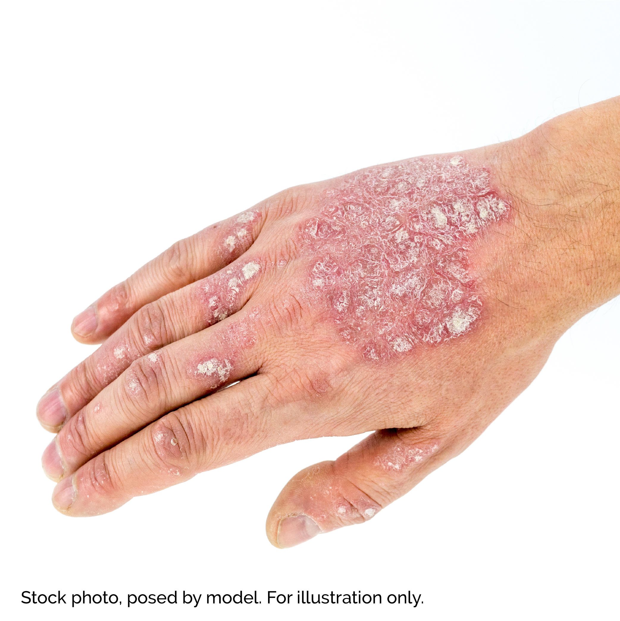 Diagnosed with Psoriasis