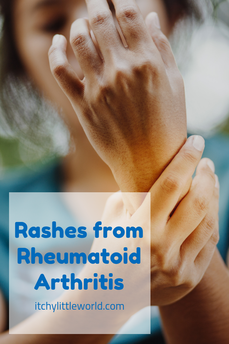 Did you know that rheumatoid arthritis and eczema are actually related ...
