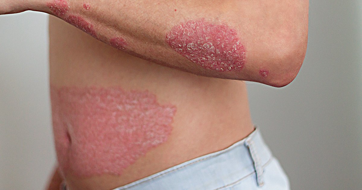 Difference Between Eczema and Psoriasis: Do You Know the ...