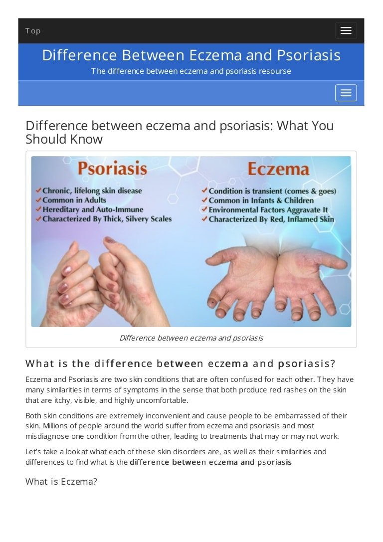 Difference between eczema and psoriasis