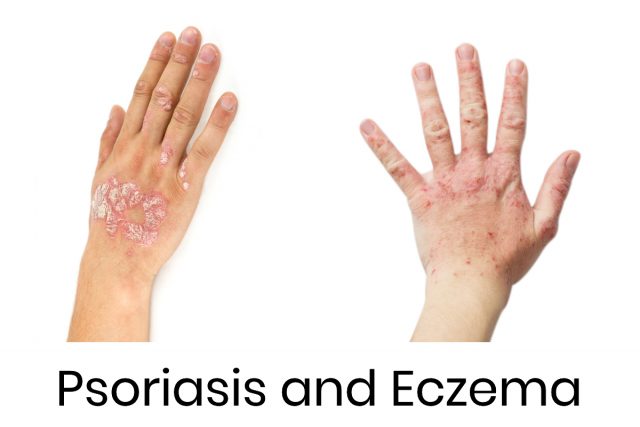 Differences between Eczema and Psoriasis