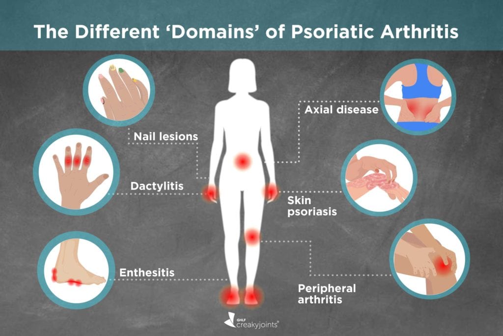 Different Types of Psoriatic Arthritis: Symptoms, Treatments, Outcomes