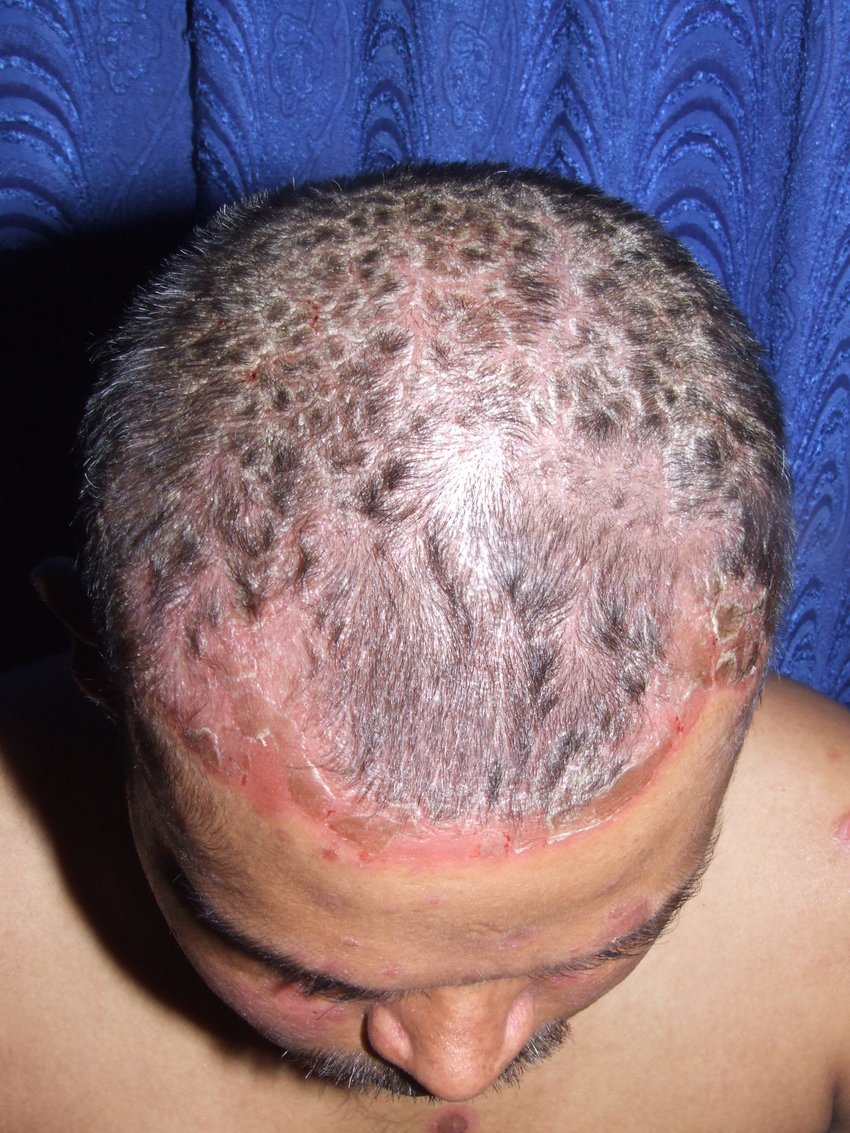 Do hair dyes cause scalp psoriasis in man?