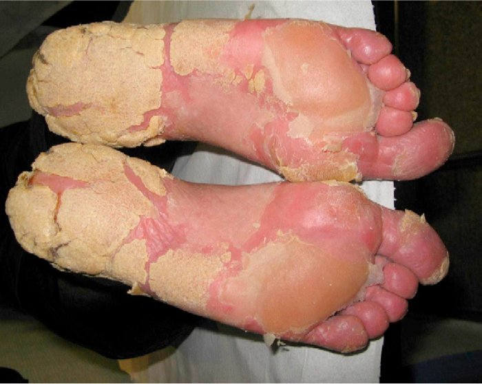 Do I Have Psoriasis of the Feet?