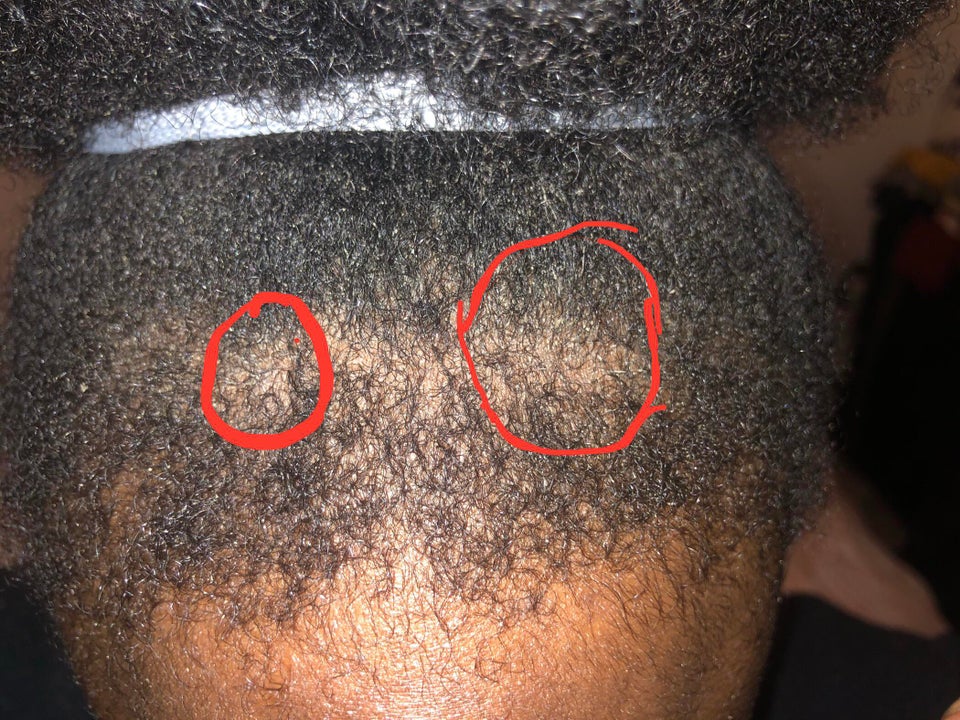 Do I have psoriasis on my scalp? If not? What is it :( I ...