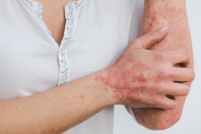 Do I Know if I Have Psoriasis? Signs and Symptoms â Stacyknows