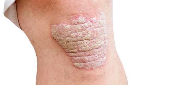 Do You Know How to Get Rid of Psoriasis Naturally? Here is ...