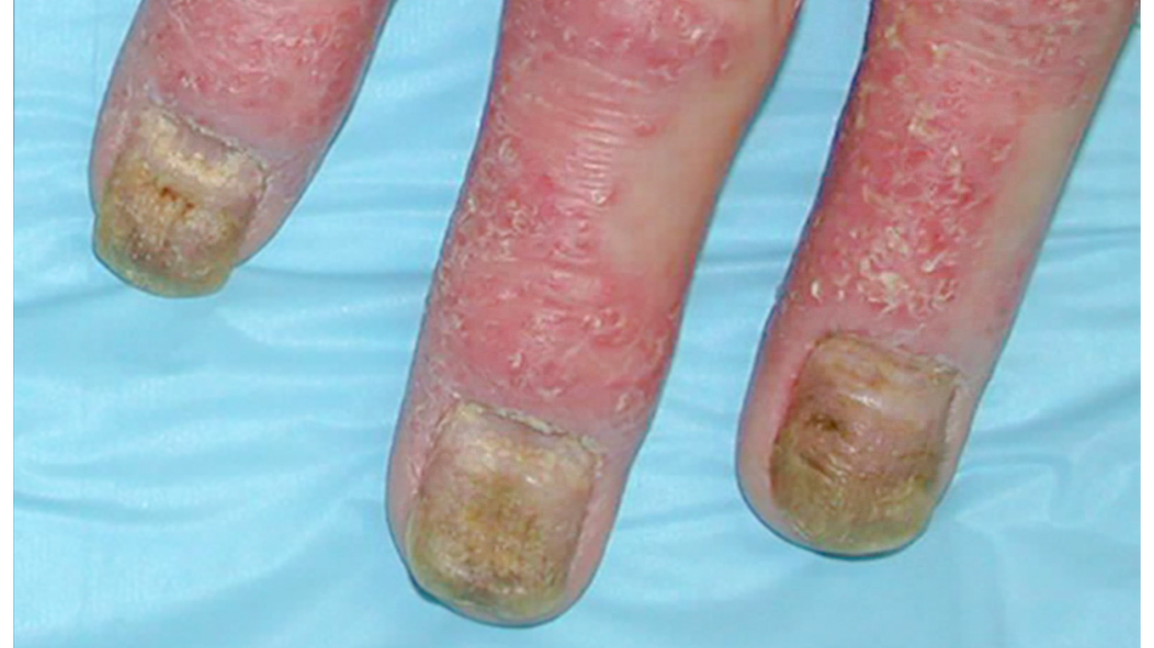Does Nail Psoriasis Go Away