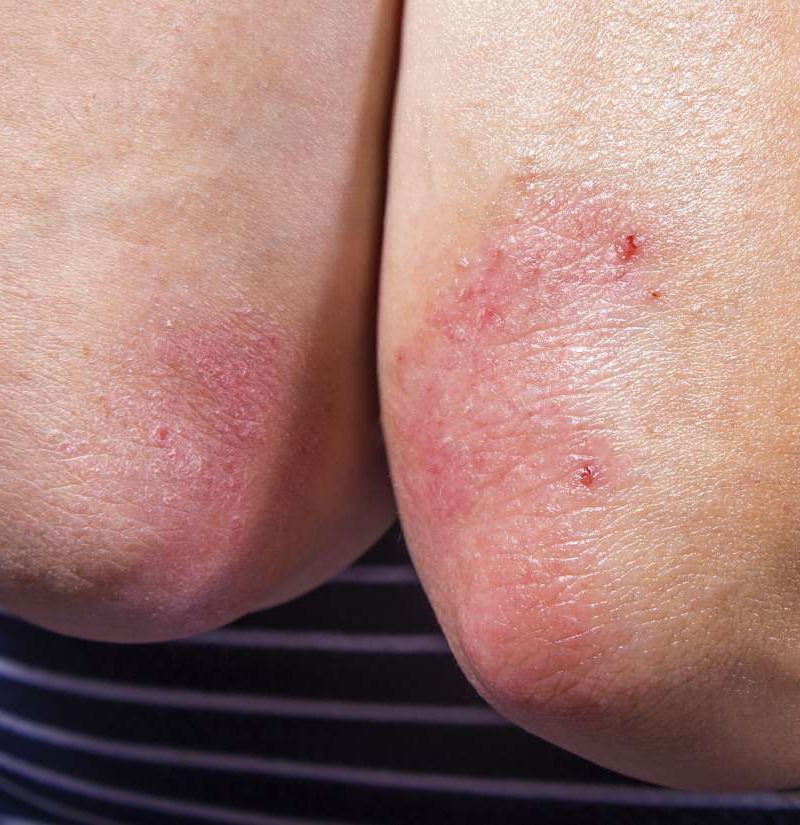 Does psoriasis spread? Facts and how to stop it