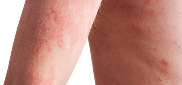 Does Psoriasis Spread If You Scratch It