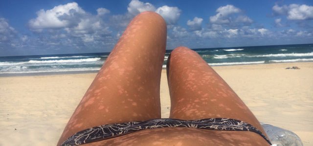 Does Sun Tanning Help Psoriasis