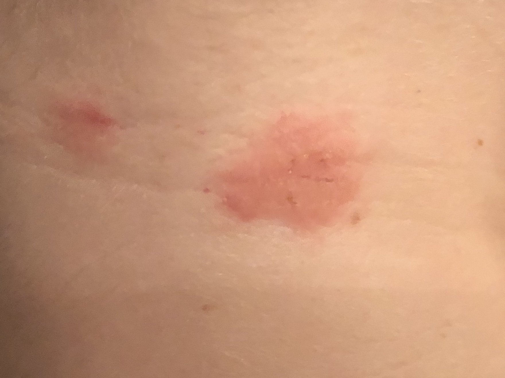 Does this look like eczema, psoriasis or something else ...