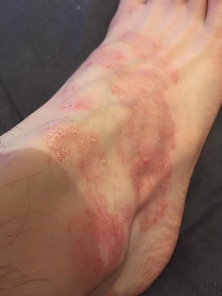 Dovonex NOT Working on Psoriasis (Pictures and Story)