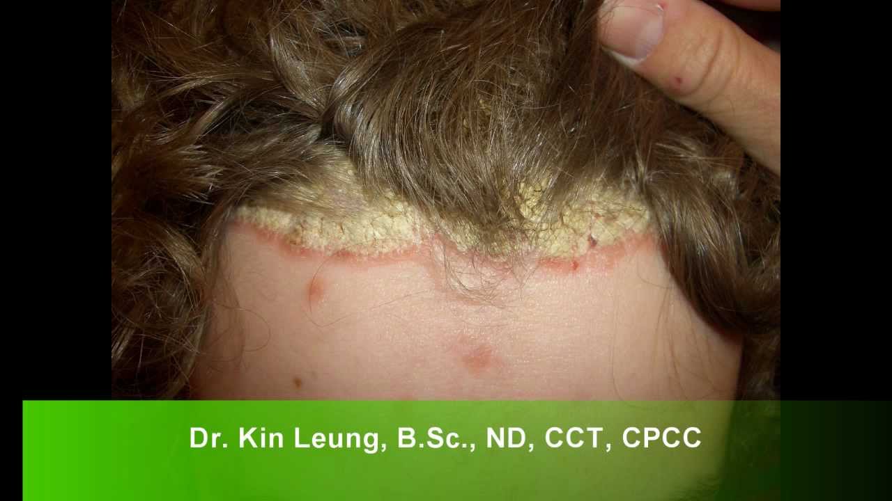 Dr Kin Leung Naturopathic Case Review Patient with ...
