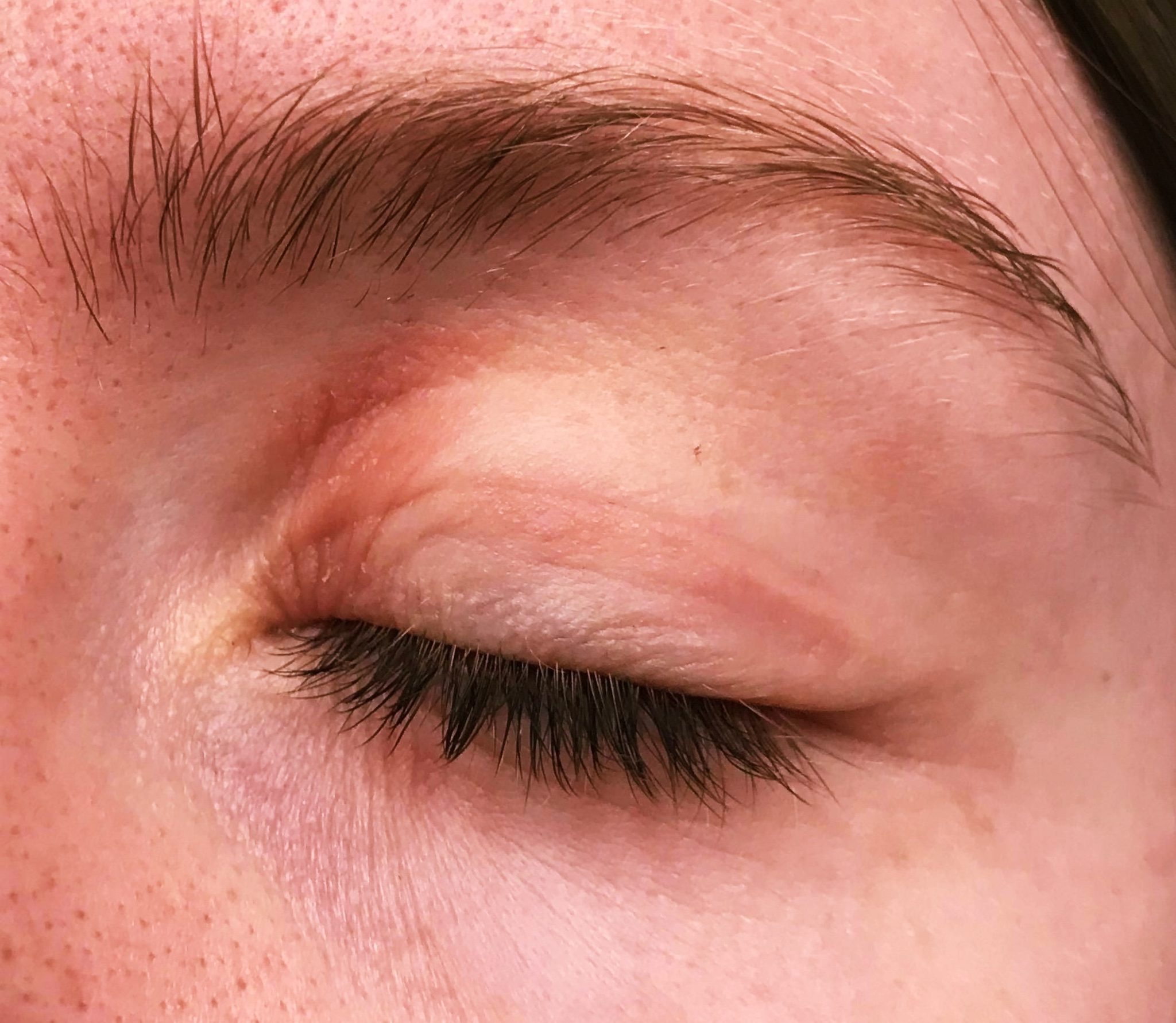 Dry Patch On Eyelid Not Itchy