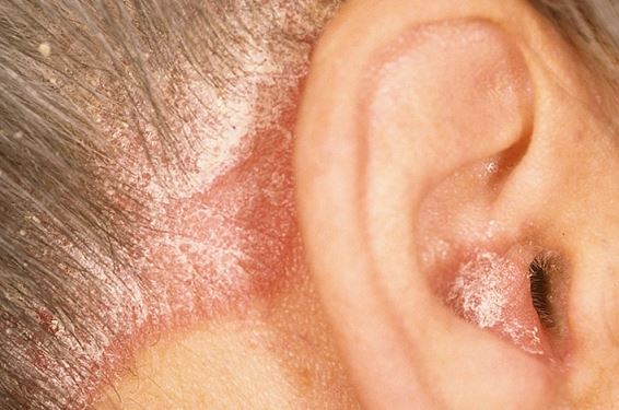 Dry Skin behind Ear, Cracked Skin, Baby, Causes, Psoriasis ...