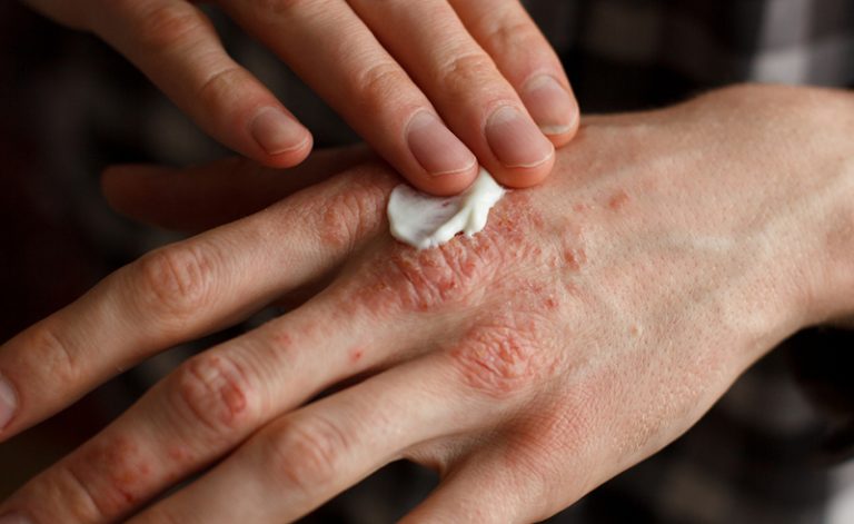 Early Psoriasis Treatment