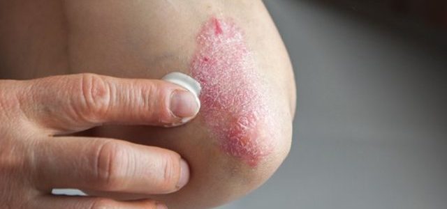 Early Signs Of Psoriasis On Elbows