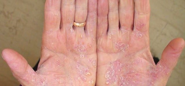 Early Signs Of Psoriasis On Hands