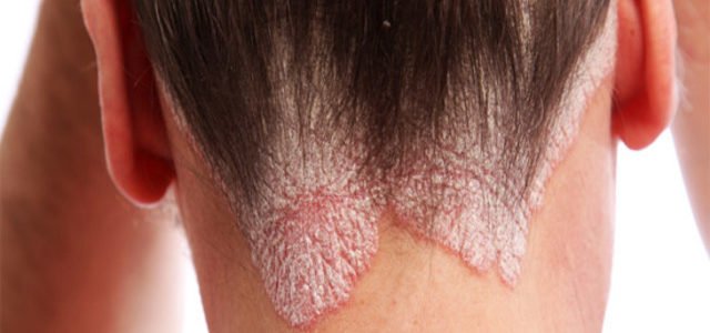 Early Signs Of Psoriasis On Scalp