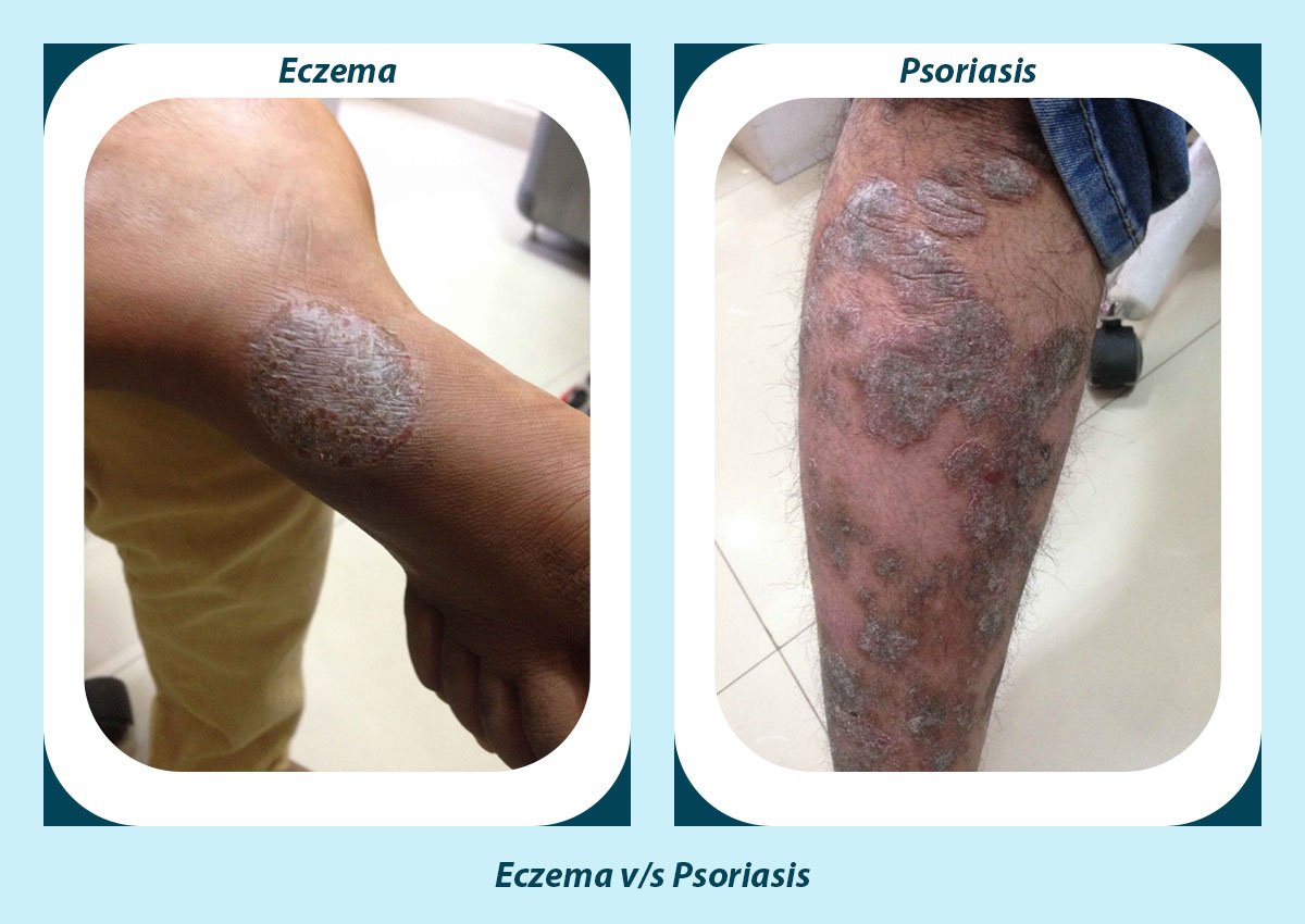 Eczema and Psoriasis at the same time? Consult now with Tibot
