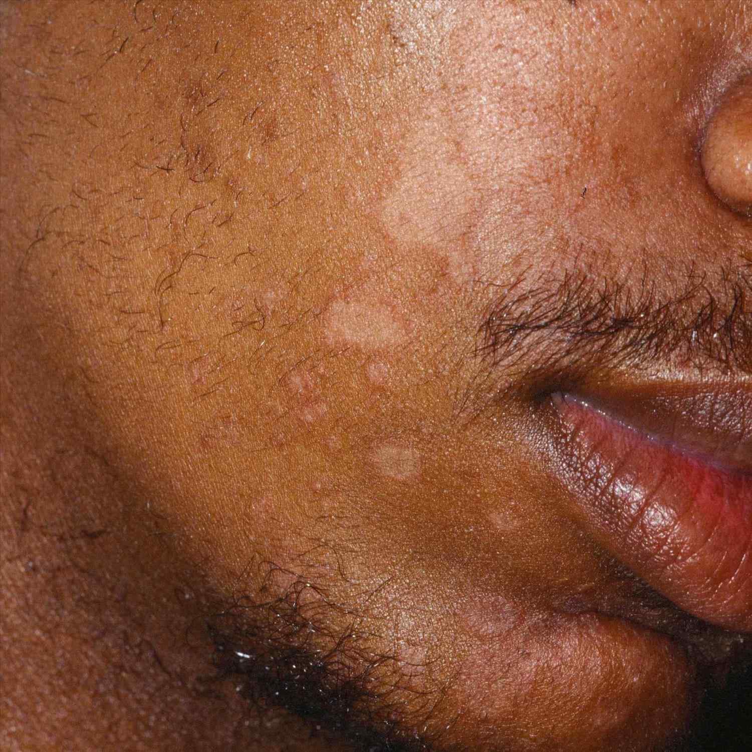 Eczema On African American Skin