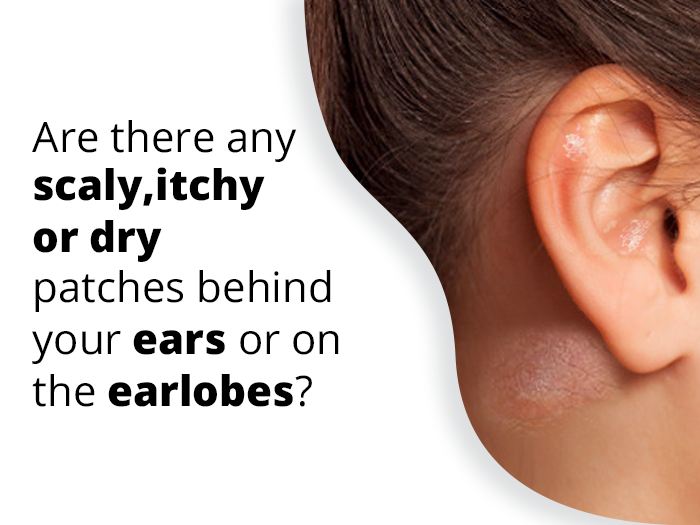 Eczema on Ear  How to Get Rid of Itchy or Dry Ear Eczema?