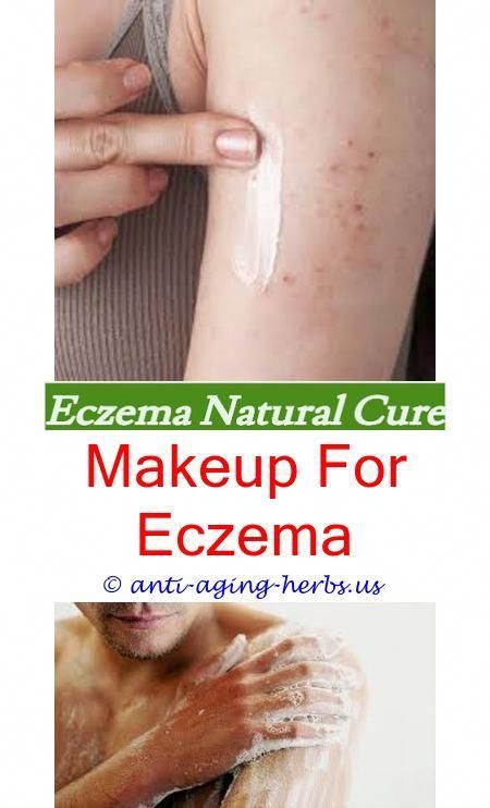 Eczema on palms and fingers.Eyelid eczema hydrocortisone ...