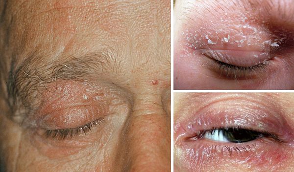 Eczema Psoriasis On Eyelid