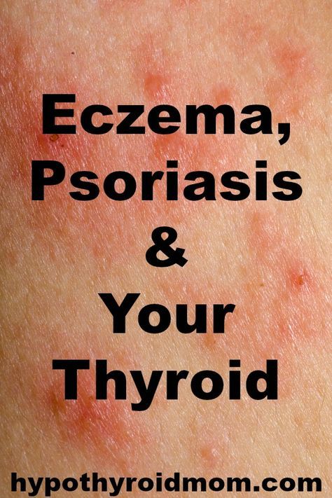 Eczema, Psoriasis &  Your Thyroid: Is There a Connection ...