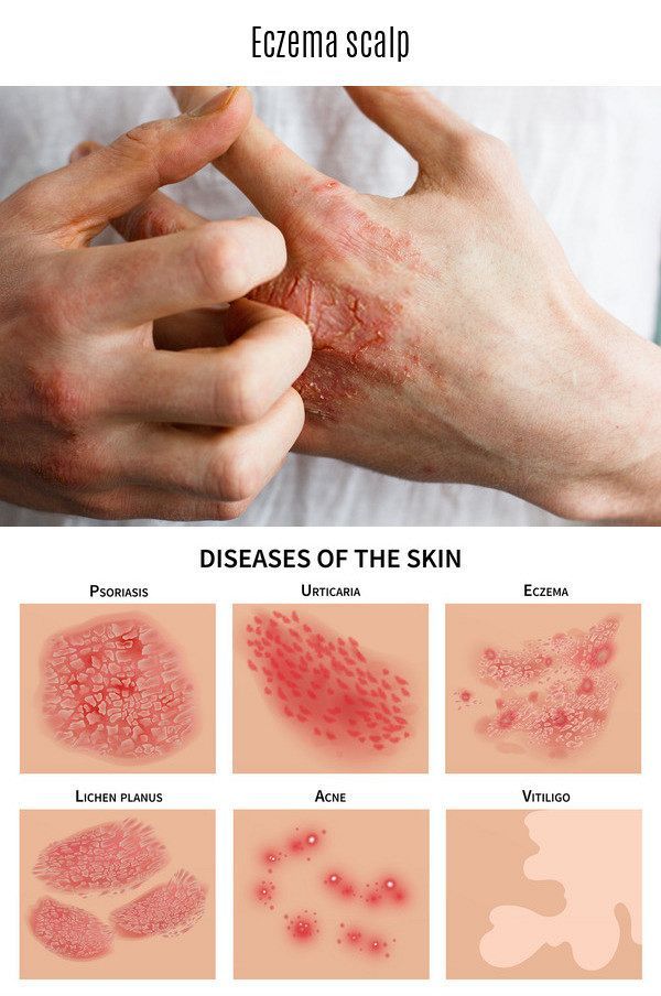 Eczema scalp. When you or someone you know is dealing with eczema, you ...