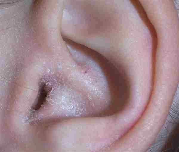 Eczema Severe Drying Out Of Skin Dermatitis Ear Canal ...