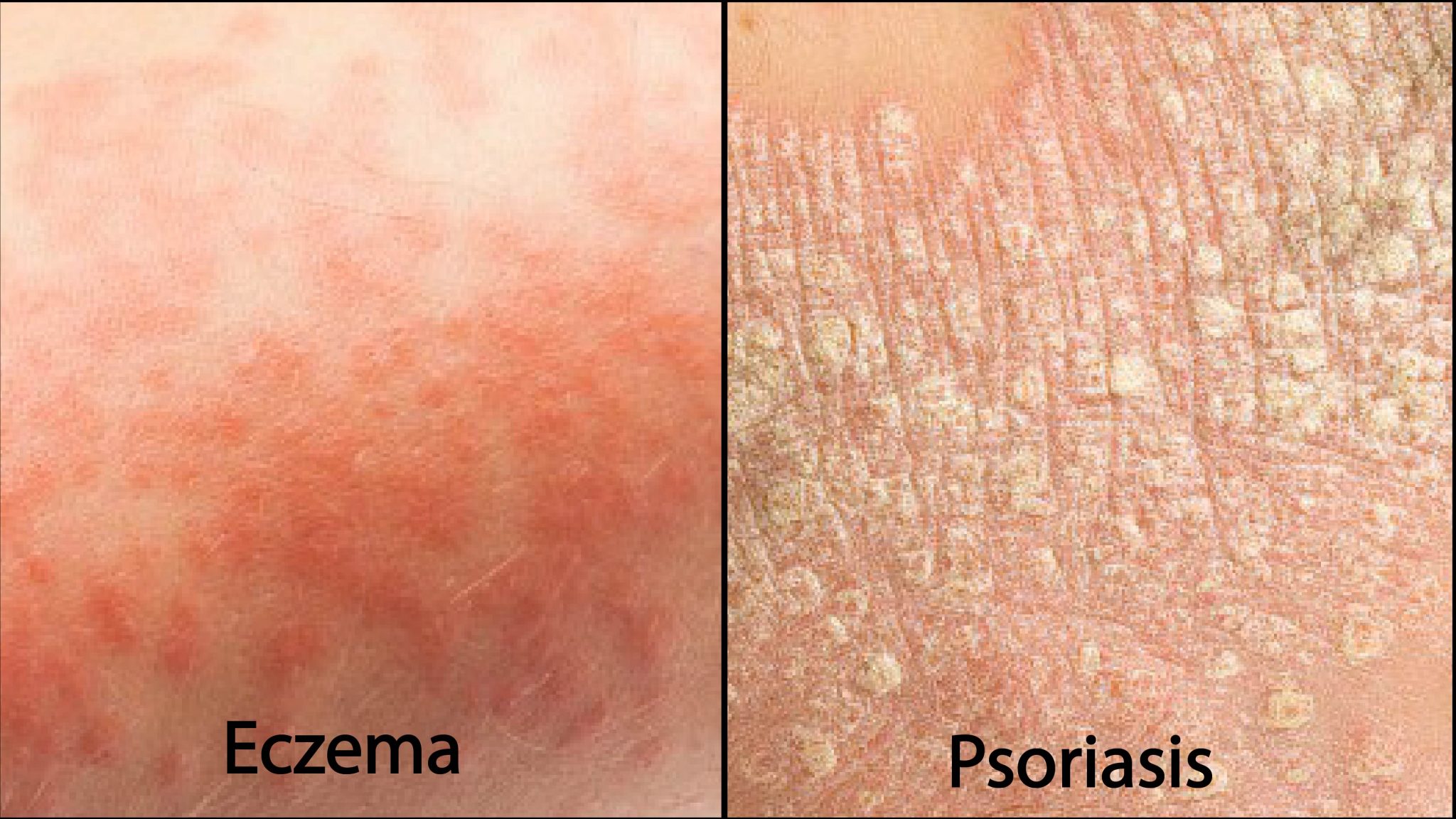 Eczema vs Psoriasis â Which One Do I Have? â Ultra Beeâ¢ With Propolis