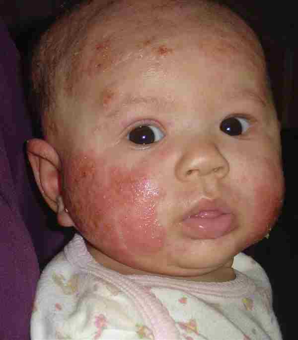Eczema Why Does It Itch Treating Baby