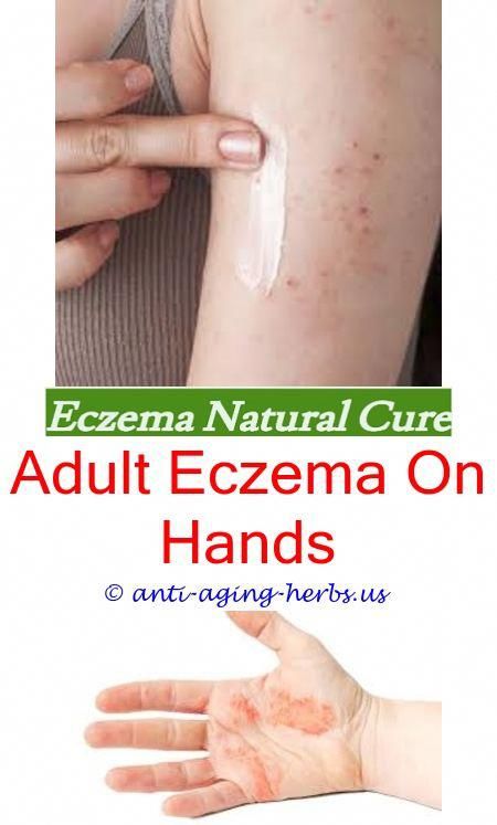 eczema: Zinc Eczema Cure