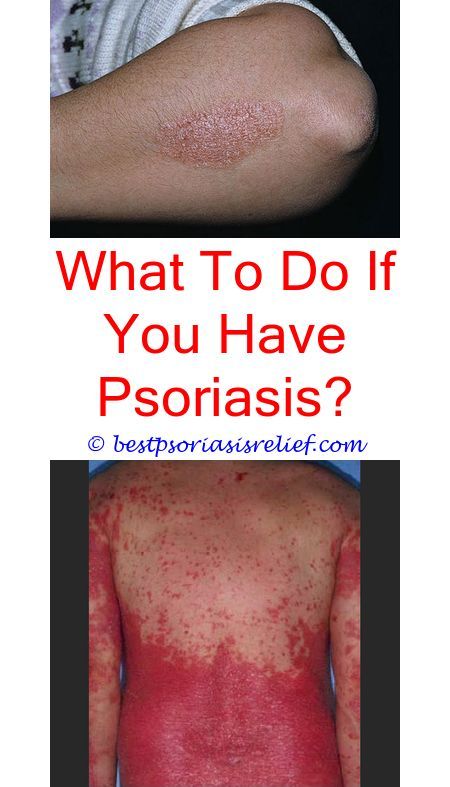 eczemapsoriasis how does psoriasis start