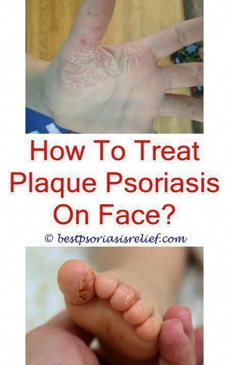 #eczemapsoriasis mild to moderate plaque #psoriasis ...