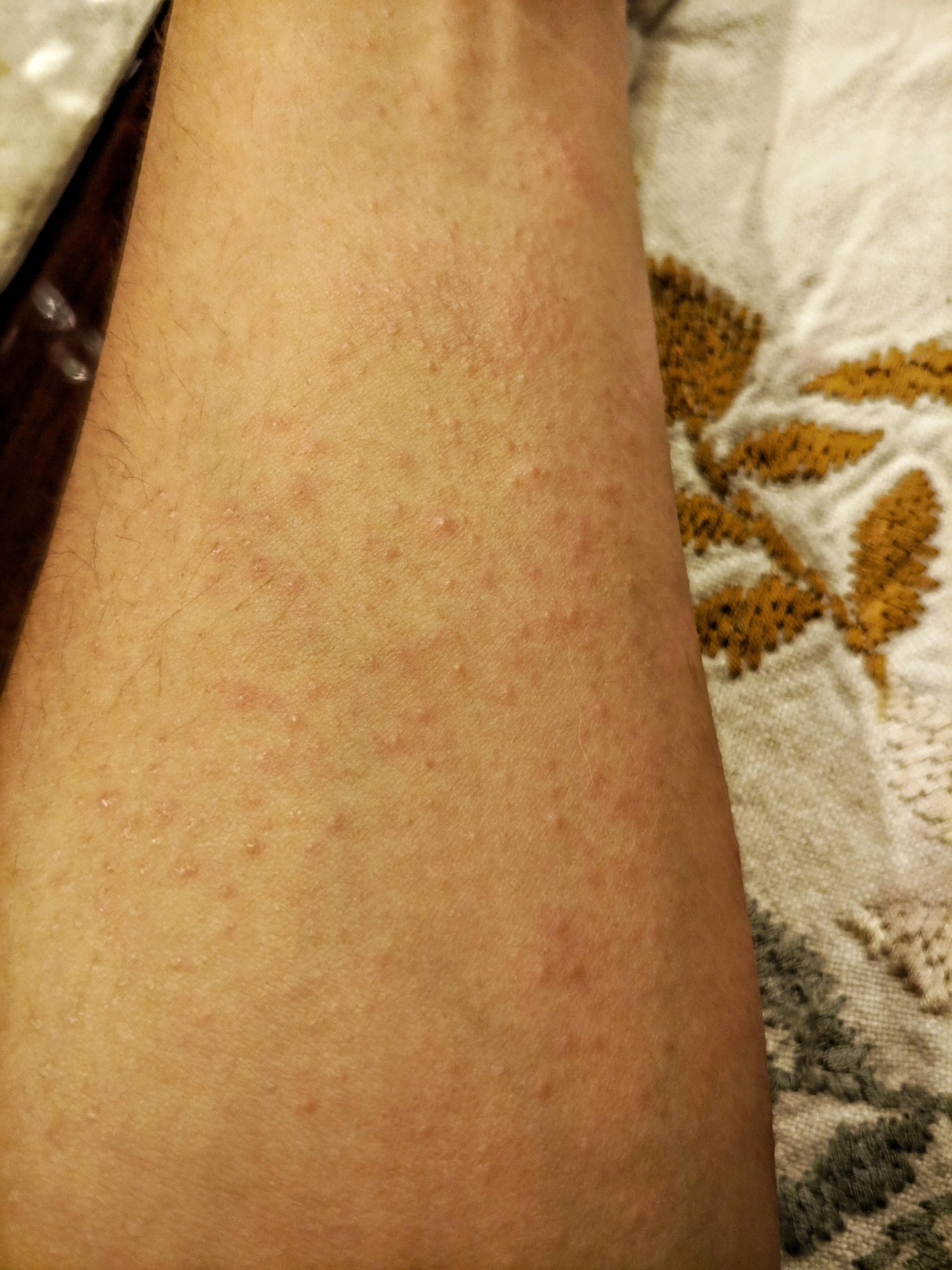 Erythrodermic Psoriasis, can anyone give me any advise what to do, like ...