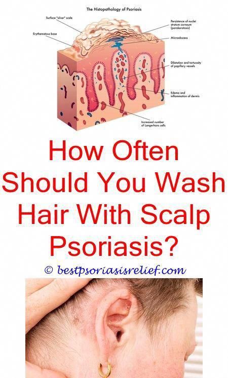 #erythrodermicpsoriasis home remedies for itchy scalp ...