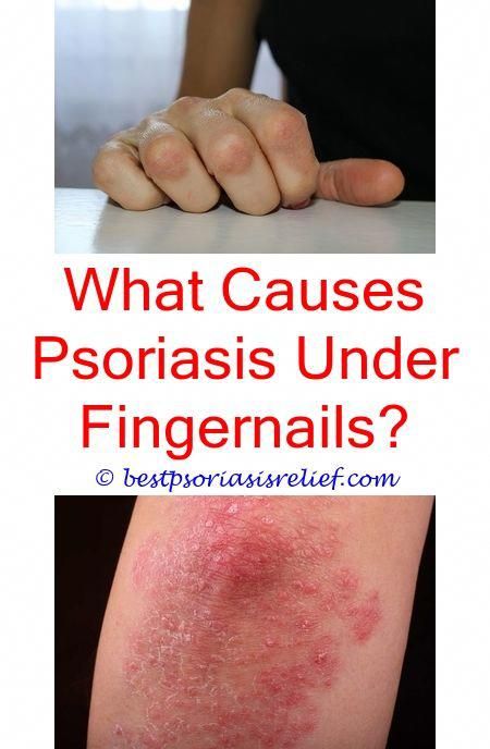 erythrodermicpsoriasis what causes scalp psoriasis to ...