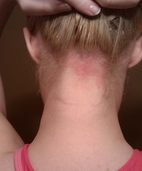 Everyday living with common Scalp psoriasis