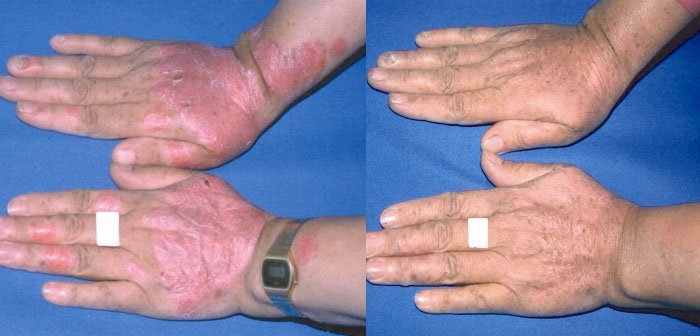 Excimer Laser for Psoriasis in New Jersey